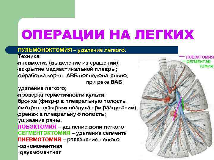  ОПЕРАЦИИ НА ЛЕГКИХ ПУЛЬМОНЭКТОМИЯ – удаление легкого.  Техника: -пневмолиз (выделение из сращений);