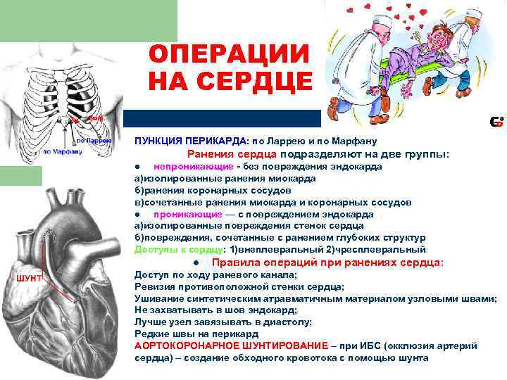   ОПЕРАЦИИ НА СЕРДЦЕ ПУНКЦИЯ ПЕРИКАРДА: по Ларрею и по Марфану  