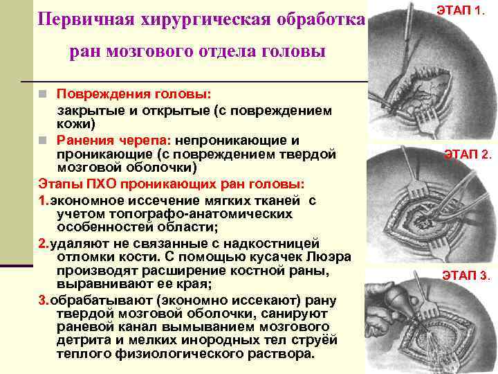     ЭТАП 1. Первичная хирургическая обработка ран мозгового отдела головы n