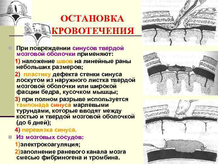    ОСТАНОВКА   КРОВОТЕЧЕНИЯ n При повреждении синусов твердой  мозговой