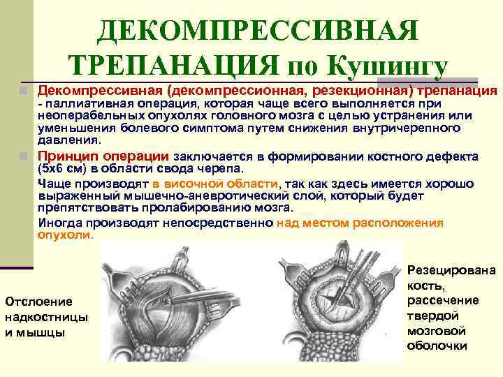    ДЕКОМПРЕССИВНАЯ   ТРЕПАНАЦИЯ по Кушингу n Декомпрессивная (декомпрессионная, резекционная) трепанация
