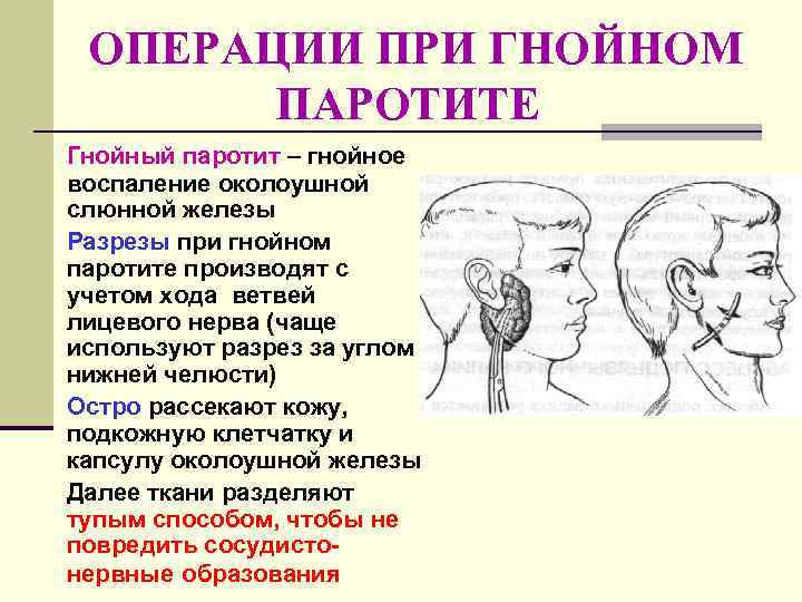  ОПЕРАЦИИ ПРИ ГНОЙНОМ  ПАРОТИТЕ Гнойный паротит – гнойное воспаление околоушной слюнной железы
