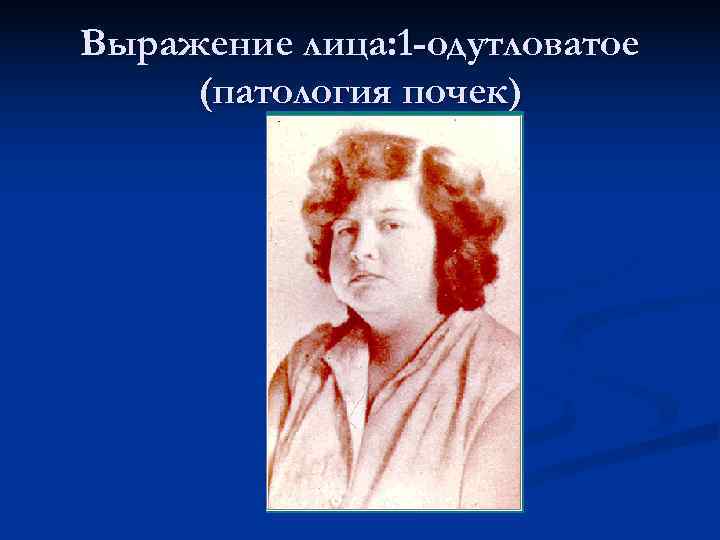 Выражение лица: 1 -одутловатое (патология почек) 