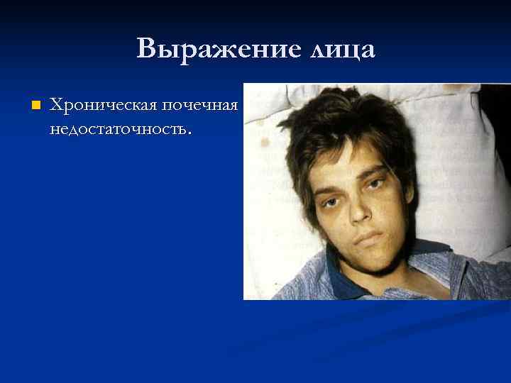    Выражение лица n  Хроническая почечная недостаточность. 