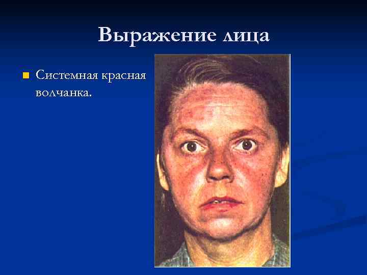    Выражение лица n  Системная красная волчанка. 