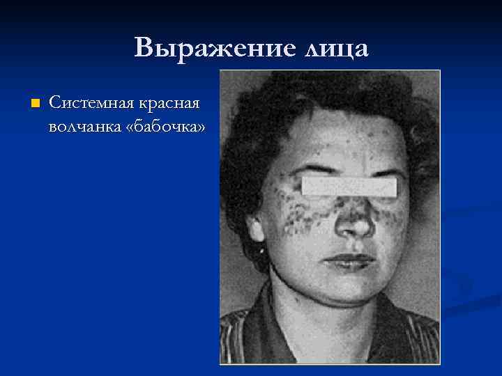   Выражение лица n  Системная красная волчанка «бабочка» 