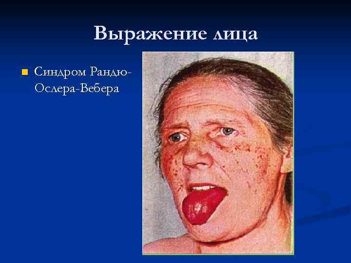   Выражение лица n  Синдром Рандю- Ослера-Вебера 