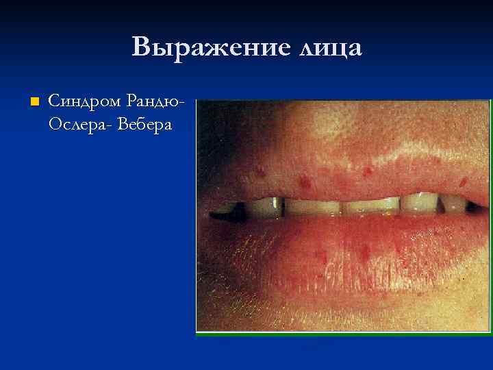   Выражение лица n  Синдром Рандю- Ослера- Вебера 