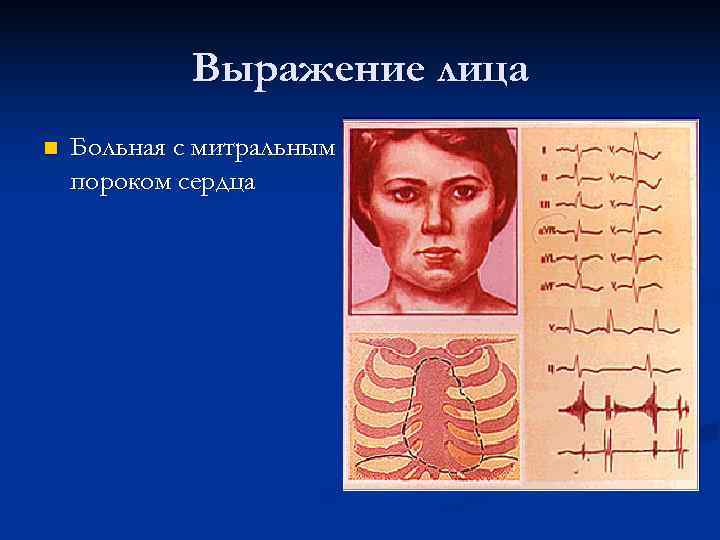    Выражение лица n  Больная с митральным пороком сердца 