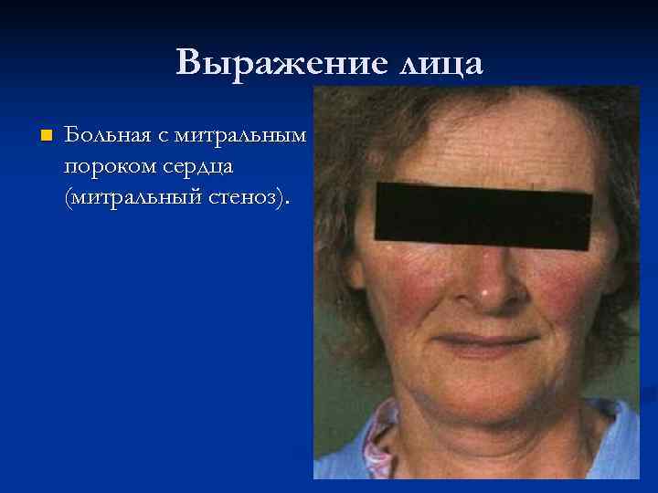    Выражение лица n  Больная с митральным пороком сердца (митральный стеноз).