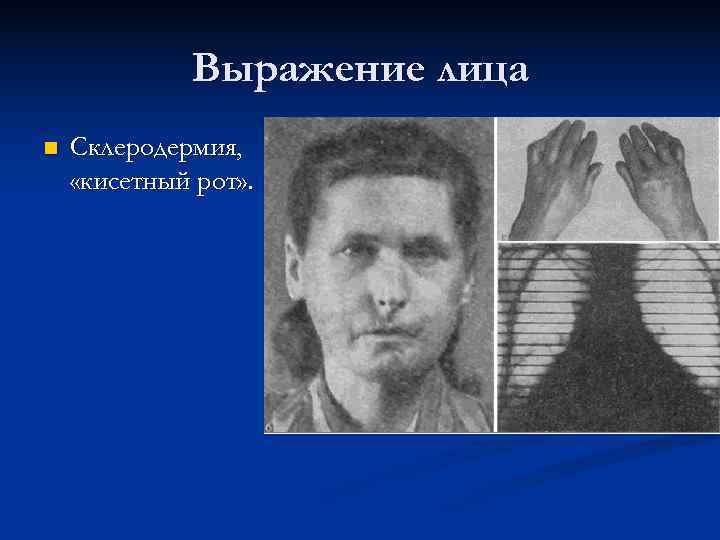    Выражение лица n  Склеродермия,  «кисетный рот» . 