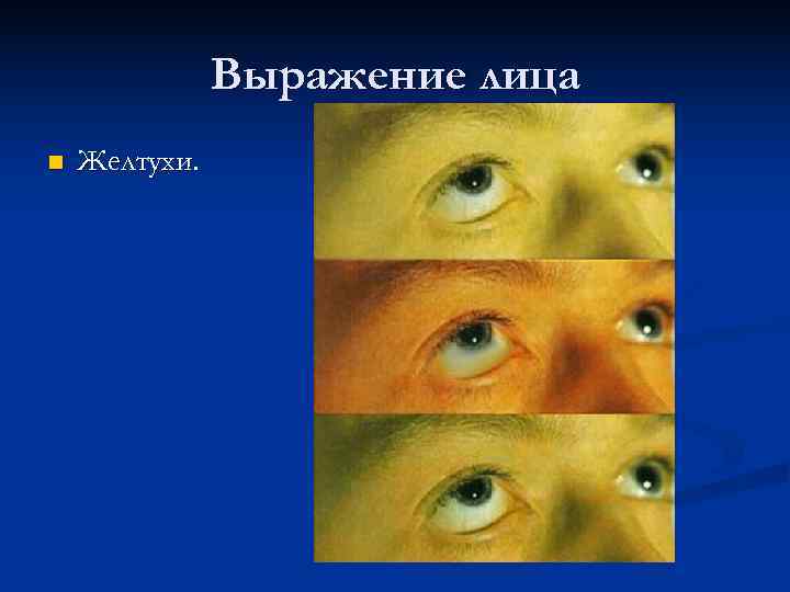     Выражение лица n  Желтухи. 
