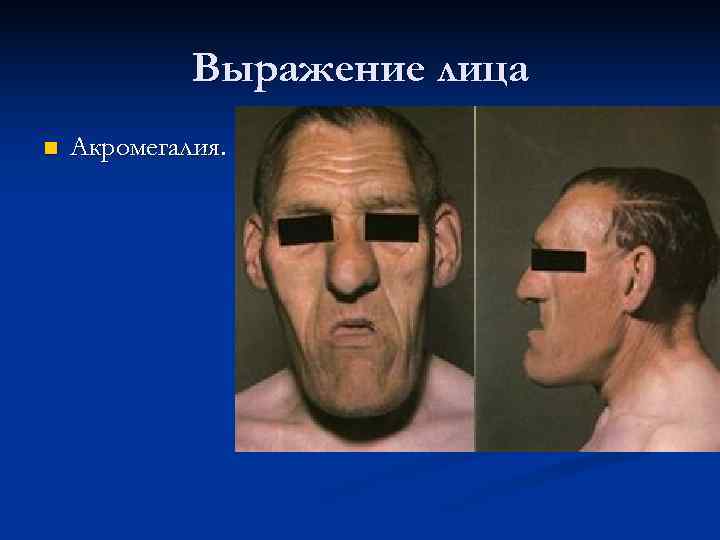    Выражение лица n  Акромегалия. 