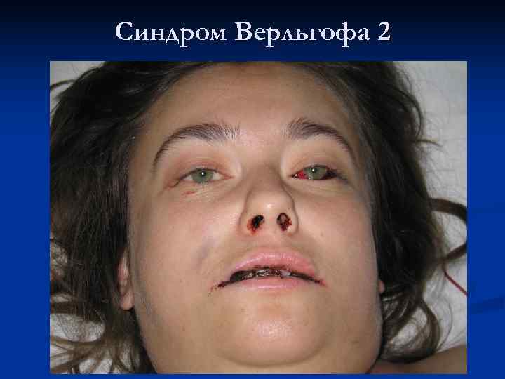 Синдром Верльгофа 2 