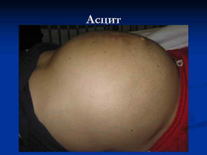 Асцит 