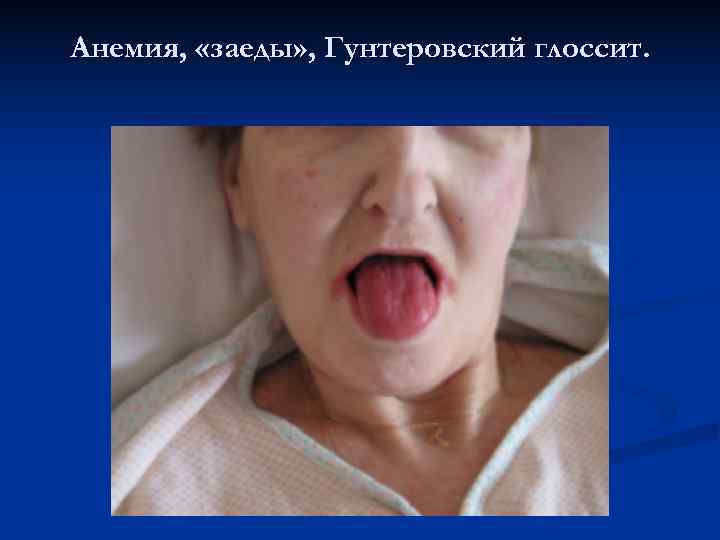 Анемия,  «заеды» , Гунтеровский глоссит. 