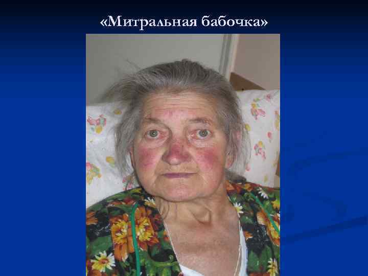  «Митральная бабочка» 