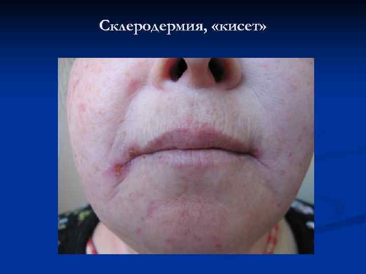 Склеродермия,  «кисет» 
