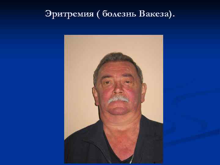 Эритремия ( болезнь Вакеза). 