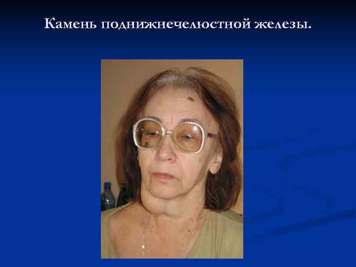 Камень поднижнечелюстной железы. 