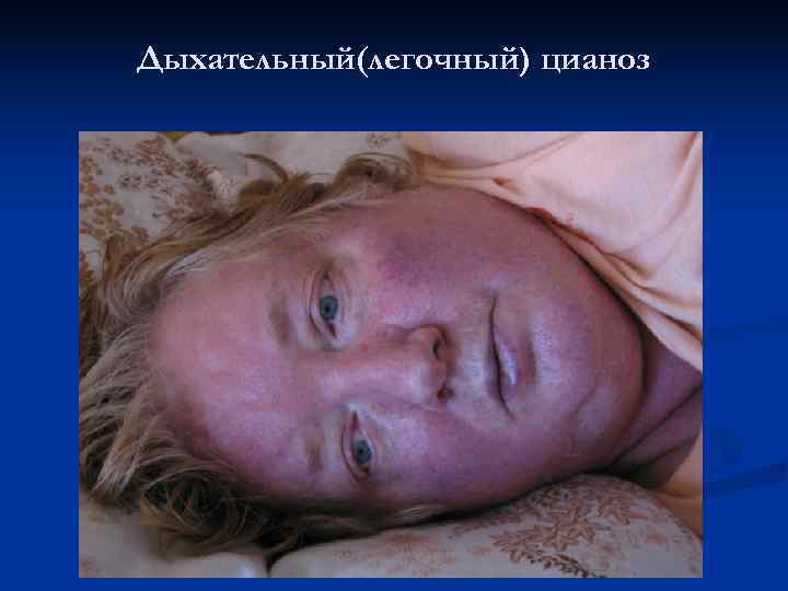 Дыхательный(легочный) цианоз 
