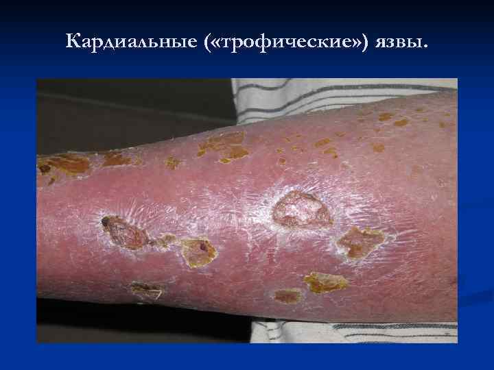 Кардиальные ( «трофические» ) язвы. 