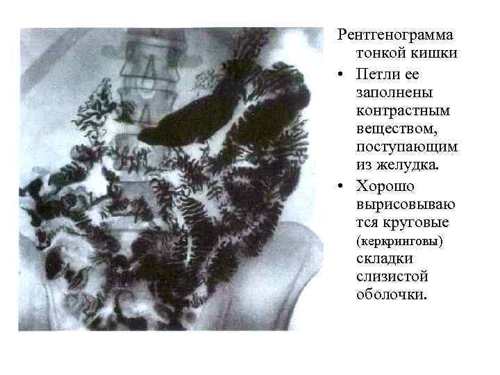 Рентгенограмма тонкой кишки • Петли ее заполнены контрастным веществом, Рентгенограмма тонкой кишки • Петли ее заполнены контрастным веществом,