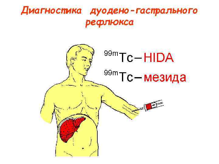 Диагностика дуодено-гастрального рефлюкса Диагностика дуодено-гастрального рефлюкса