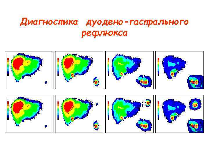 Диагностика дуодено-гастрального рефлюкса Диагностика дуодено-гастрального рефлюкса