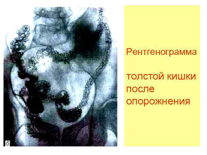 Рентгенограмма толстой кишки после опорожнения 