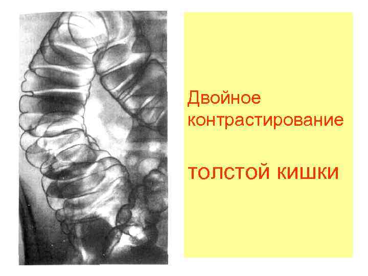 Двойное контрастирование толстой кишки 