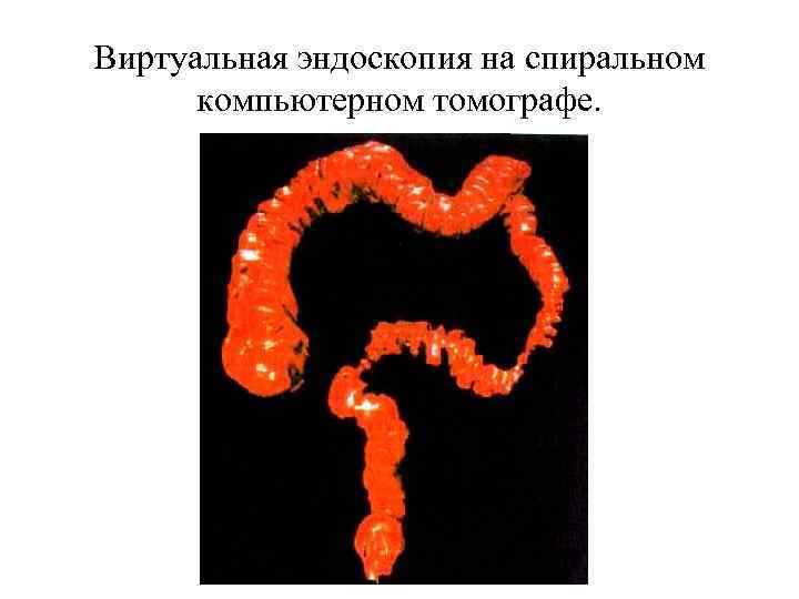 Виртуальная эндоскопия на спиральном  компьютерном томографе. 