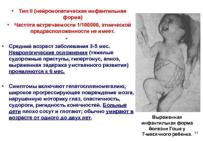  • Тип II (нейронопатическая инфантильная     форма)  • Частота
