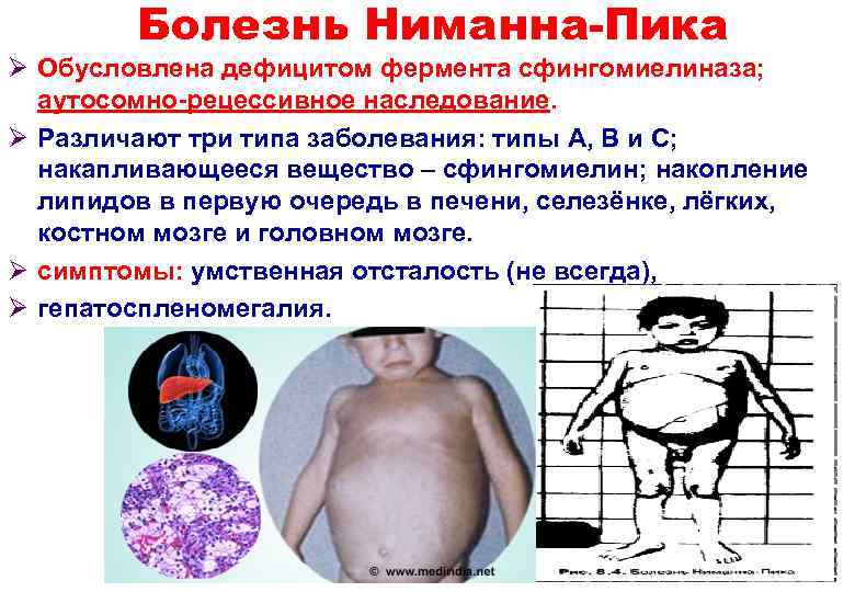   Болезнь Ниманна-Пика Ø Обусловлена дефицитом фермента сфингомиелиназа; аутосомно-рецессивное наследование.  Ø Различают