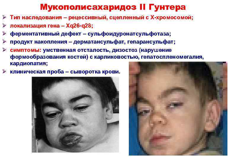   Мукополисахаридоз II Гунтера Ø Тип наследования – рецессивный, сцепленный с Х-хромосомой; Ø