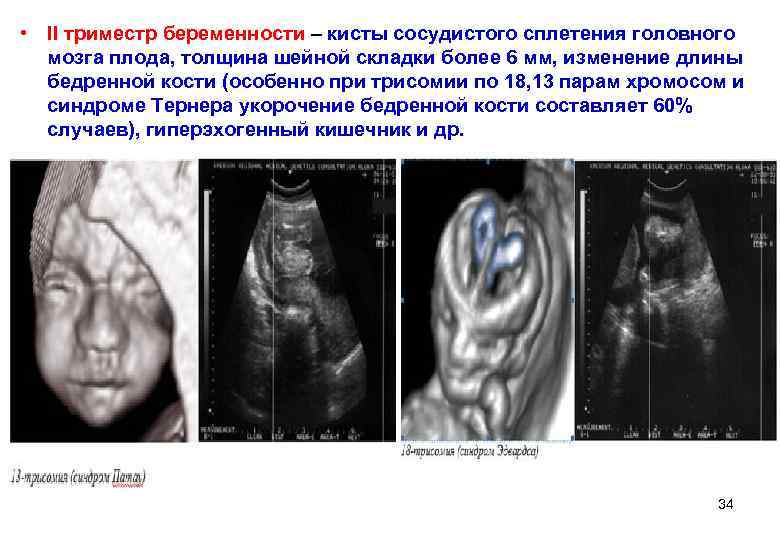  • II триместр беременности – кисты сосудистого сплетения головного  мозга плода, толщина