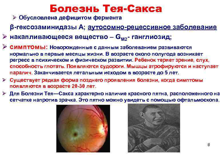     Болезнь Тея-Сакса  Ø Обусловлена дефицитом фермента  β-гексозаминидазы А;