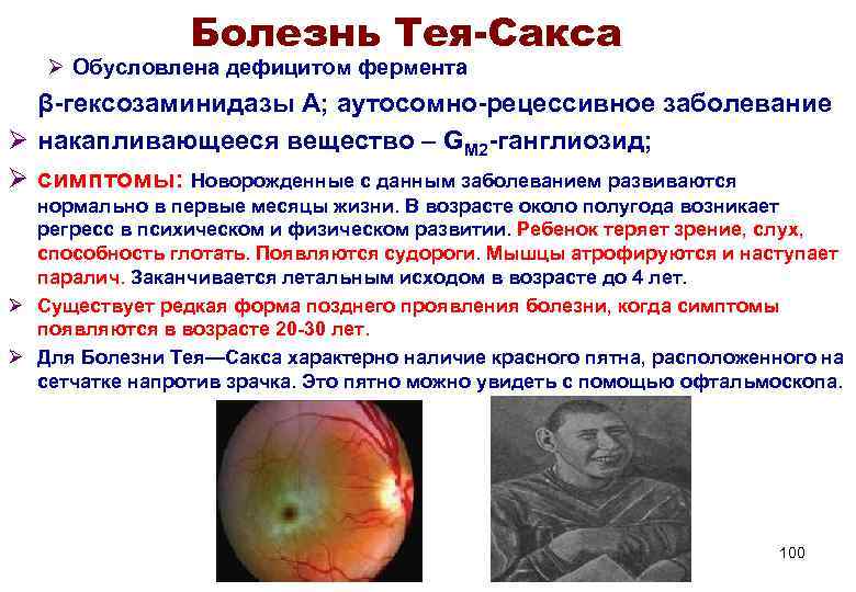     Болезнь Тея-Сакса  Ø Обусловлена дефицитом фермента  β-гексозаминидазы А;
