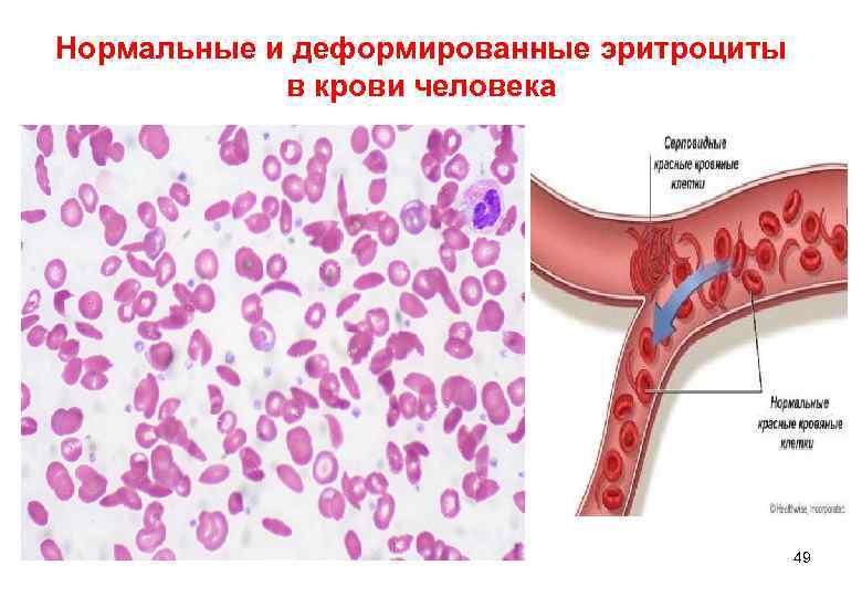 Нормальные и деформированные эритроциты   в крови человека    49 