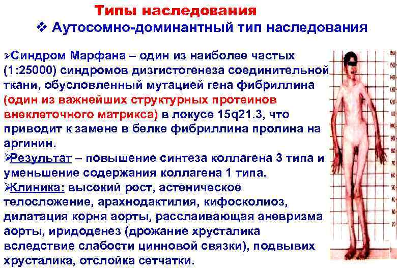   Типы наследования v Аутосомно-доминантный тип наследования ØСиндром Марфана – один из наиболее