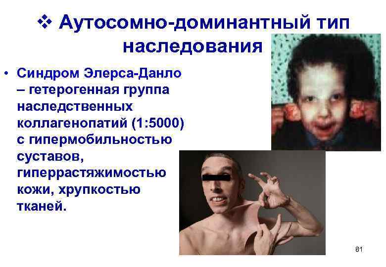   v Аутосомно-доминантный тип   наследования • Синдром Элерса-Данло  – гетерогенная
