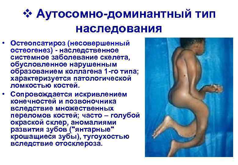  v Аутосомно-доминантный тип   наследования • Остеопсатироз (несовершенный  остеогенез) - наследственное