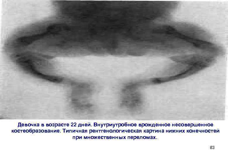  Девочка в возрасте 22 дней. Внутриутробное врожденное несовершенное костеобразование. Типичная рентгенологическая картина нижних