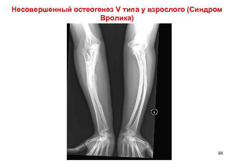 Несовершенный остеогенез V типа у взрослого (Синдром    Вролика)   