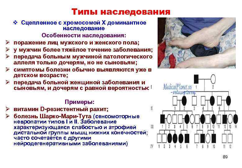      Типы наследования v Сцепленное с хромосомой Х доминантное 