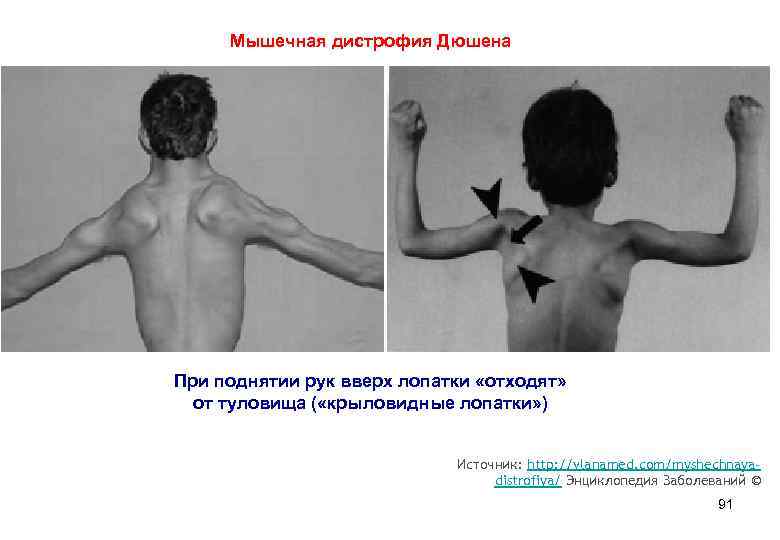  Мышечная дистрофия Дюшена При поднятии рук вверх лопатки «отходят» от туловища ( «крыловидные
