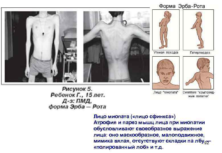 Лицо миопата ( «лицо сфинкса» ) Атрофия и парез мышц лица при миопатии обусловливают