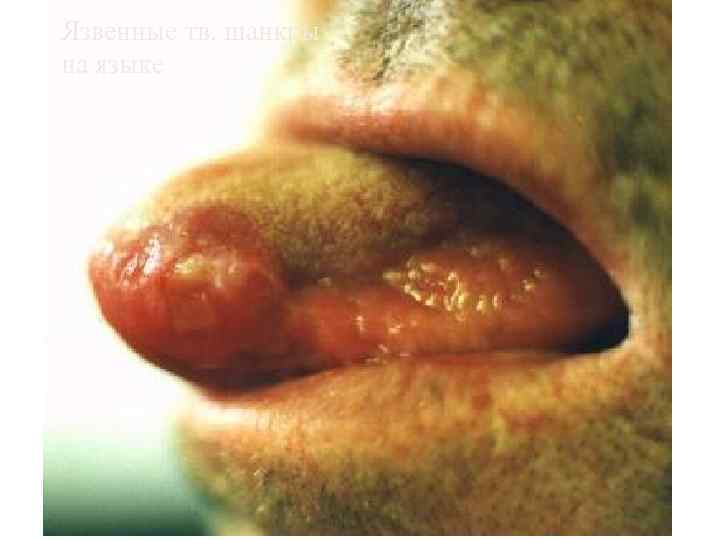 Язвенные тв. шанкры на языке 