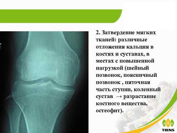 2. Затвердение мягких тканей: различные отложения кальция в костях и суставах, в местах с