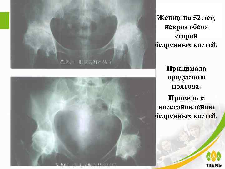  Женщина 52 лет, некроз обеих  сторон бедренных костей.  Принимала  продукцию